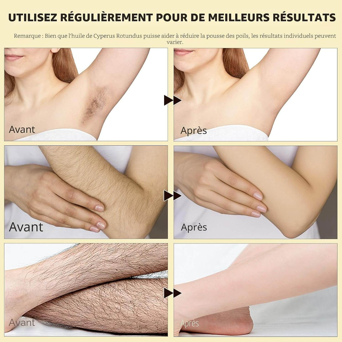 SmoothSkin™ – En finir avec vos poils du visage