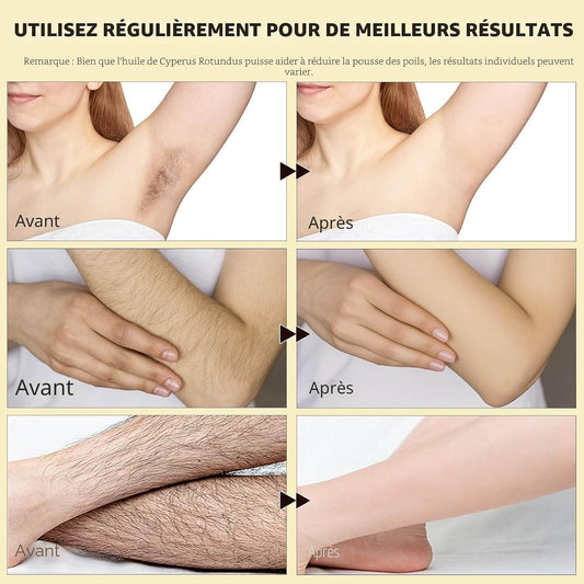 SmoothSkin™ – En finir avec vos poils du visage